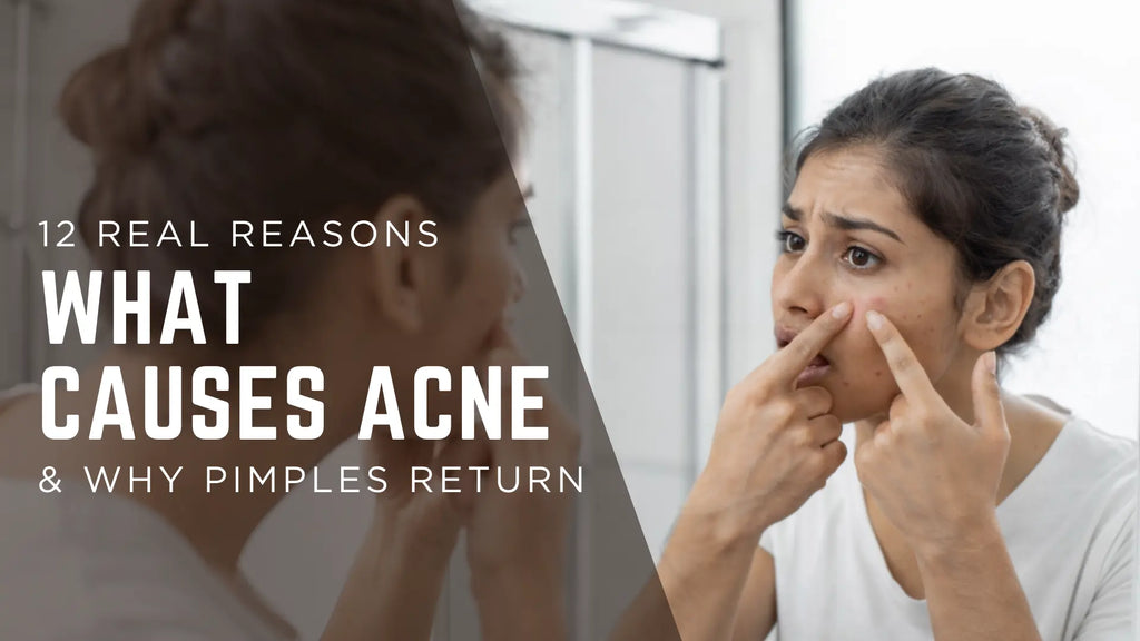 12 Real Reasons What Causes Acne & Why Pimples Return